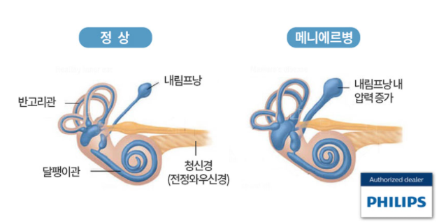 한쪽귀먹먹